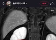 “捏捏”博主自曝患癌退圈引热议，“解压神器”为何成了健康隐患？